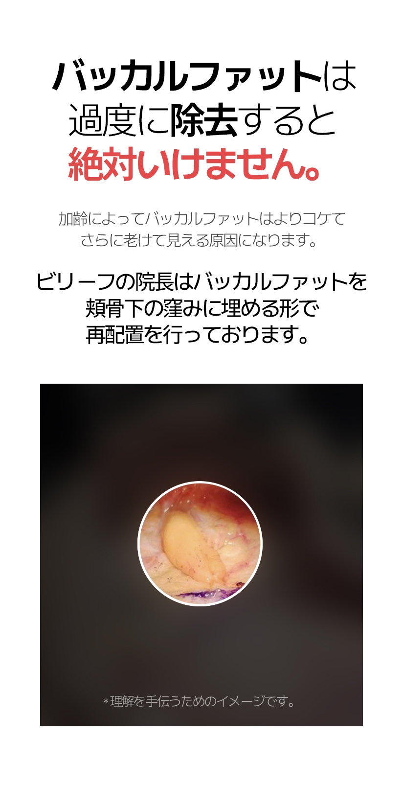 バッカルファットは 過度に除去すると 絶対いけません。加齢によってバッカルファットはよりコケて さらに老けて見える原因になります。ビリーフの院長はバッカルファットを 頬骨下の窪みに埋める形で 再配置を行っております。* 理解を手伝うためのイメージです。