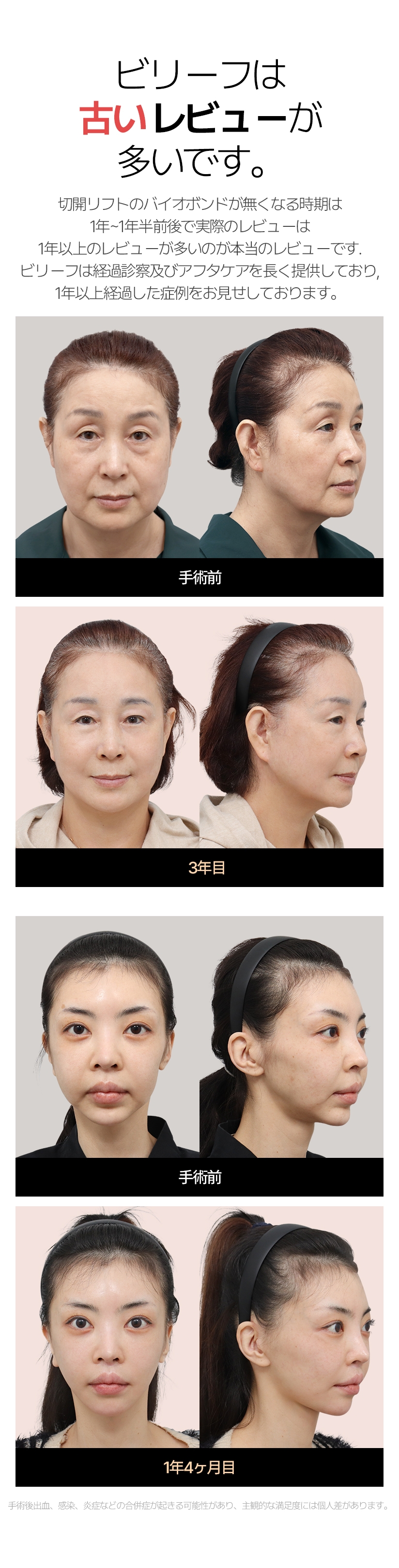 ビリーフは 古いレビューが多いです。切開リフトのバイオボンドが無くなる時期は1年~1年半前後で実際のレビューは 1年以上のレビューが多いのが本当のレビューです。ビリーフは経過診察及びアフタケアを長く提供しており, 1年以上経過した症例をお見せしております。手術前     3年目 手術前     1年4ヶ月目 手術後出血, 感染, 炎症などの合併症が起きる可能性があり, 主観的な満足度には個人差があります。