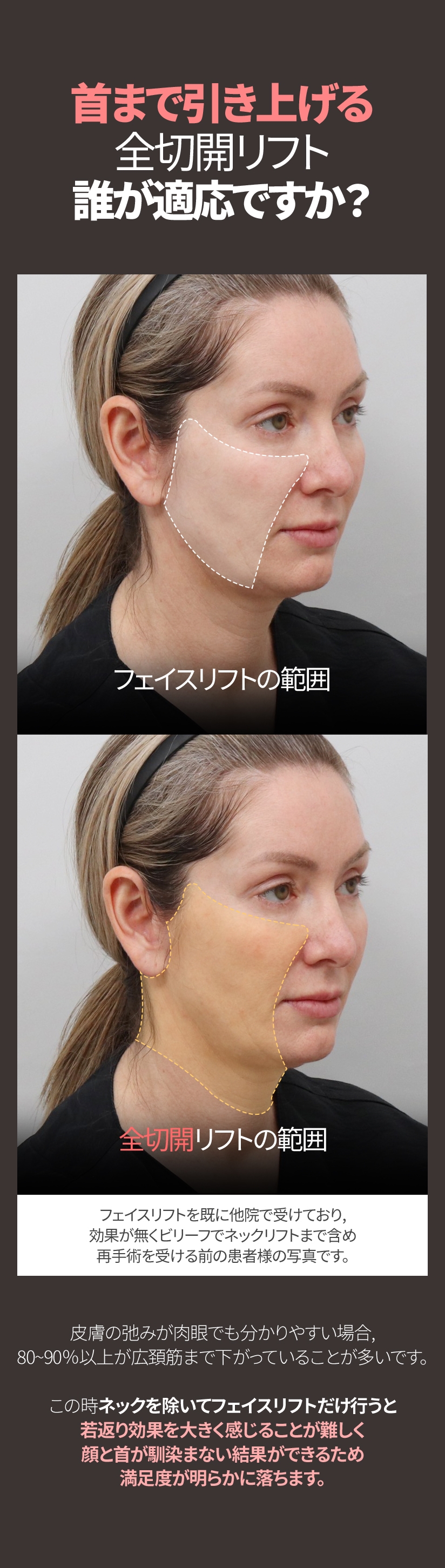 首まで引き上げる 全切開リフト誰が適応ですか? フェイスリフトの範囲 全切開リフトの範囲 フェイスリフトを既に他院で受けており, 効果が無くビリーフでネックリフトまで含め 再手術を受ける前の患者様の写真です。皮膚の弛みが肉眼でも分かりやすい場合, 80~90％以上が広頚筋まで下がっていることが多いです。この時ネックを除いてフェイスリフトだけ行うと若返り効果を大きく感じることが難しく 顔と首が馴染まない結果ができるため満足度が明らかに落ちます。