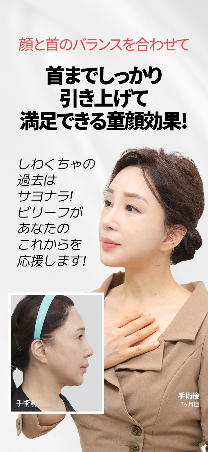 顔と首のバランスを合わせて 首までしっかり引き上げて 満足できる童顔効果! しわくちゃの過去は サヨナラ! ビリーフがあなたの これからを応援します! 手術前  手術後 7ヶ月目 
