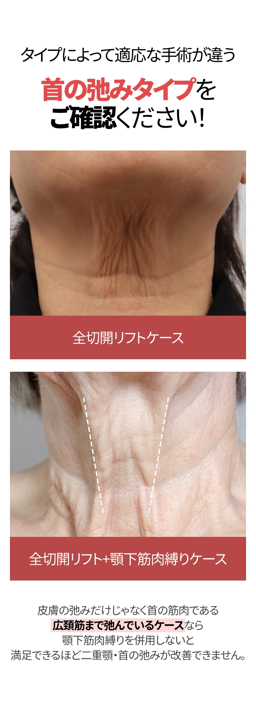 タイプによって適応な手術が違う 首の弛みタイプをご確認ください！ 全切開リフトケース 全切開リフト+顎下筋肉縛りケース 皮膚の弛みだけじゃなく首の筋肉である広頚筋まで弛んでいるケースなら 顎下筋肉縛りを併用しないと満足できるほど二重顎・首の弛みが改善できません。