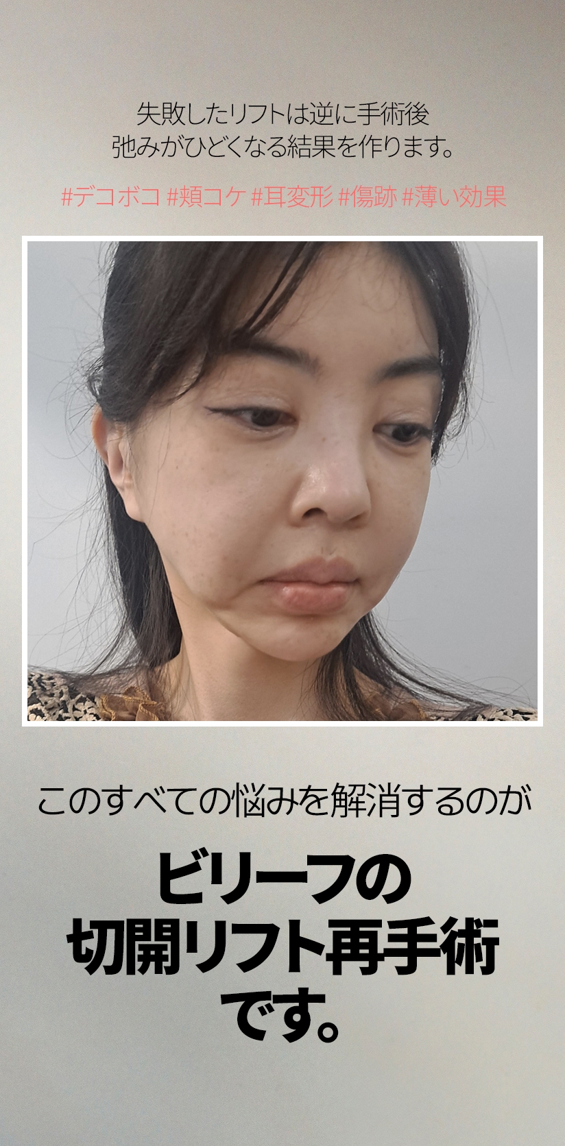 失敗したリフトは逆に手術後 弛みがひどくなる結果を作ります。 #デコボコ #頬コケ #耳変形 #傷跡 #薄い効果 このすべての悩みを 解消するのが ビリーフの 切開リフト再手術 です。