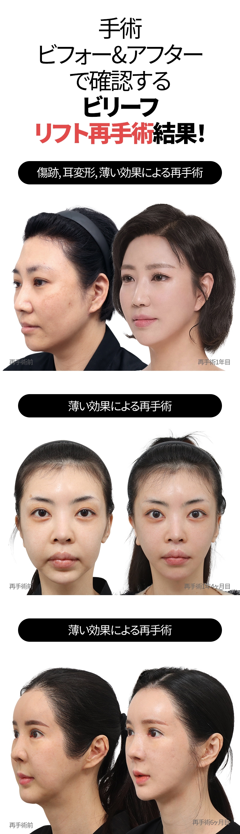 手術ビフォー&アフターで確認する ビリーフリフト再手術結果! 傷跡, 耳変形, 薄い効果による再手術 再手術前  再手術1年目 薄い効果による再手術 再手術前 再手術1年4ヶ月目 薄い効果による再手術 再手術前 再手術6ヶ月目