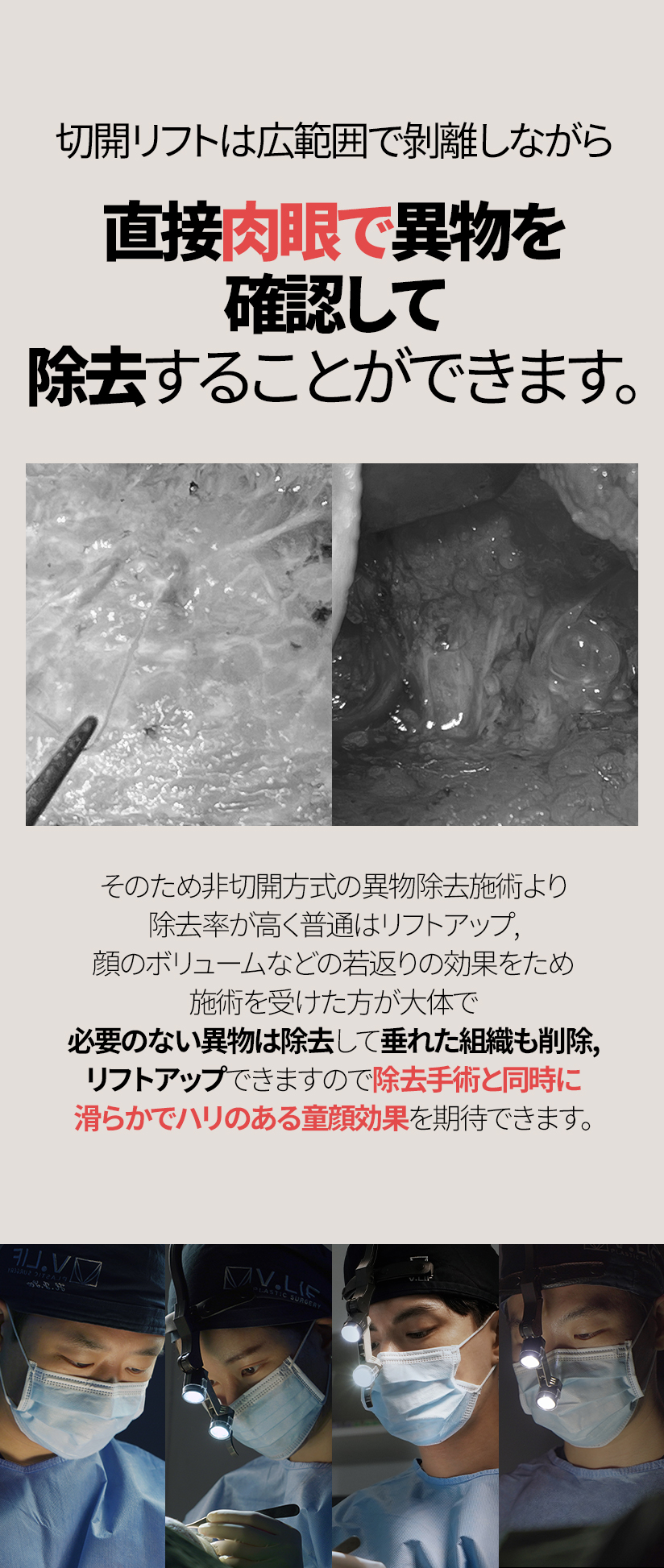 切開リフトは広範囲で剝離しながら 直接肉眼で異物を確認して 除去することができます。そのため非切開方式の異物除去施術より除去率が高く 普通はリフトアップ、顔のボリュームなどの若返りの効果をため施術を受けた方が大体で 必要のない異物は除去して垂れた組織も削除, リフトアップできますので 除去手術と同時に滑らかでハリのある童顔効果を期待できます。