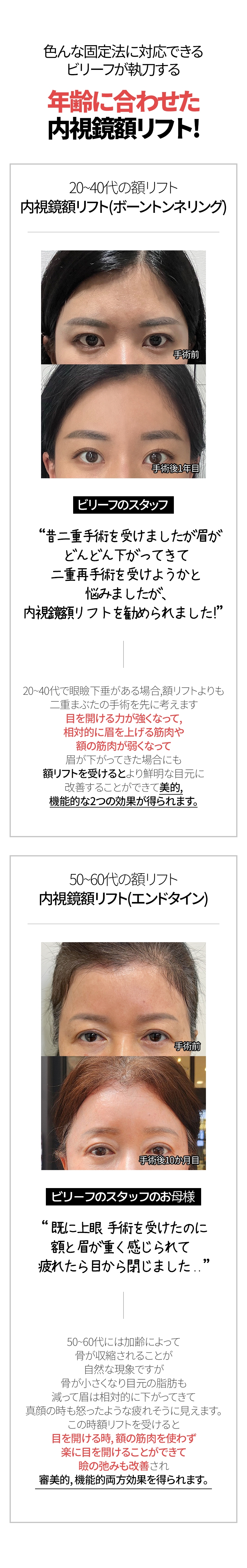 色んな固定法に対応できるビリーフが執刀する 年齢に合わせた内視鏡額リフト!  20 ~ 40代の額リフト 内視鏡額リフト(ボーントンネリング) 手術前 手術後1年目 ビリーフのスタッフ “昔二重手術を受けましたが眉が どんどん下がってきて二重再手術を受けようかと 悩みましたが、内視鏡額リフトを勧められました!” 20~40代で眼瞼下垂がある場合, 額リフトよりも二重まぶたの手術を先に考えます。 目を開ける力が強くなって, 相対的に眉を上げる筋肉や額の筋肉が弱くなって 眉が下がってきた場合にも額リフトを受けるとより鮮明な目元に 改善することができて美的, 機能的な2つの効果が得られます。50 ~ 60代の額リフト 内視鏡額リフト(エンドタイン) 手術前 手術後10か月目 ビリーフのスタッフのお母様 “ 既に上眼 手術を受けたのに額と眉が重く感じられて 疲れたら目から閉じました ..” 50~60代には加齢によって骨が収縮されることが自然な現象ですが 骨が小さくなり目元の脂肪も減って眉は相対的に 下がってきて真顔の時も怒ったような, 疲れそうに見えます。 この時額リフトを受けると目を開ける時, 額の筋肉を使わず 楽に目を開けることができて瞼の弛みも改善され 審美的, 機能的両方効果を得られます。