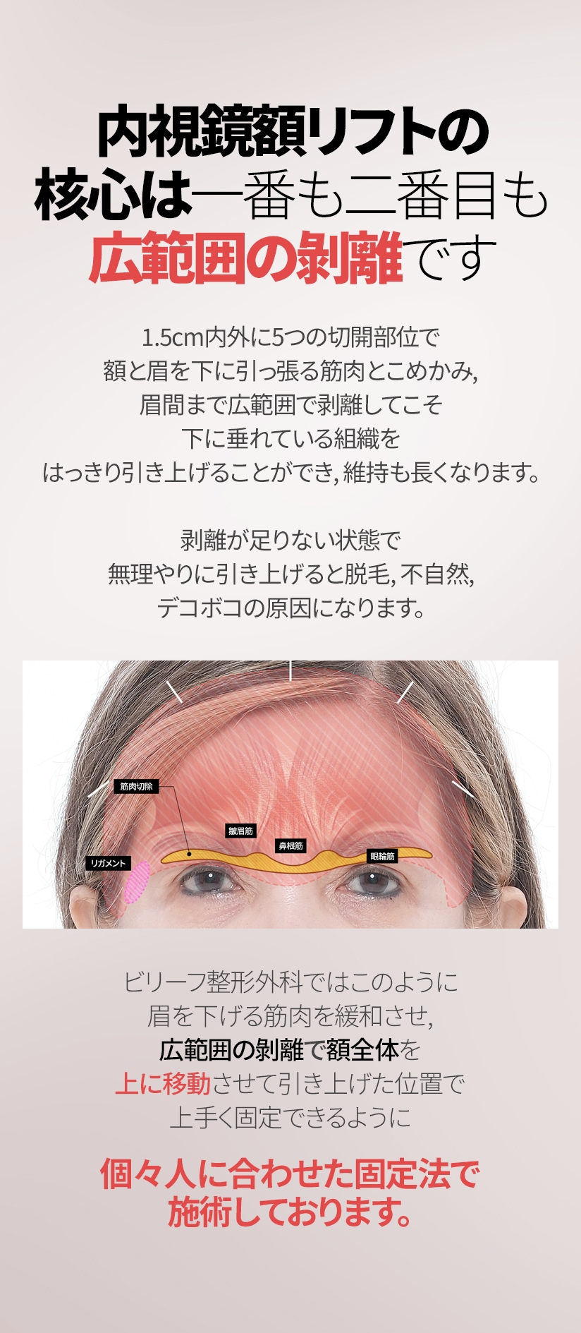 内視鏡額リフトの核心は 一番も二番目も広範囲の剝離です。 1.5cm内外に5つの切開部位で額と眉を下に引っ張る筋肉とこめかみ, 眉間まで 広範囲で剥離してこそ下に垂れている組織をはっきり引き上げることができ, 維持も長くなります。剥離が足りない状態で無理やりに引き上げると脱毛, 不自然, デコボコの原因になります。 リガメント 筋肉切除 皺眉筋 鼻根筋 眼輪筋 ビリーフ整形外科ではこのように眉を下げる筋肉を緩和させ, 広範囲の剝離で額全体を上に移動させて引き上げた位置で上手く固定できるように 個々人に合わせた固定法で施術しております。