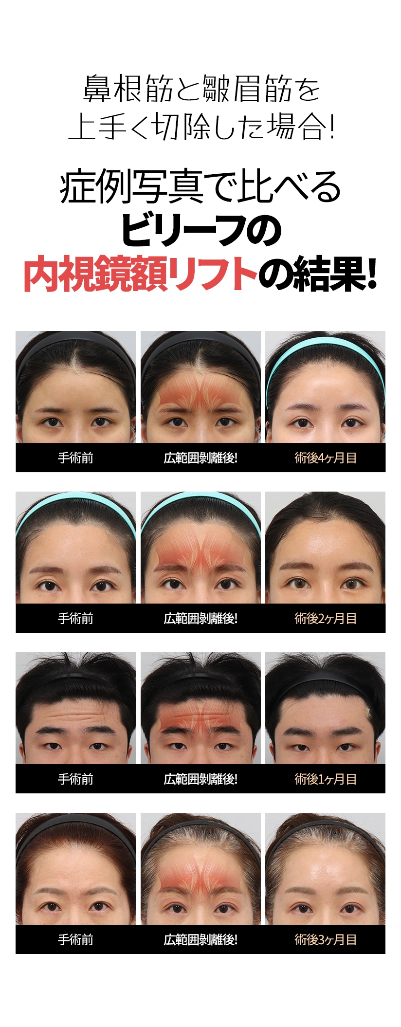 鼻根筋と皺眉筋を上手く切除した場合! 症例写真で比べる ビリーフの内視鏡額リフトの結果! 手術前  広範囲剝離後! 術後4ヶ月目  手術前 広範囲剝離後! 術後2ヶ月目  手術前 広範囲剝離後! 術後1ヶ月目 手術前 広範囲剝離後! 術後3ヶ月目 