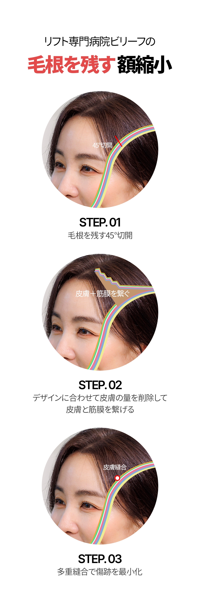 リフト専門病院ビリーフの  毛根を残す 額縮小 STEP. 01 毛根を残す 45°切開 STEP. 02 デザインに合わせて 皮膚の量を削除して 皮膚と筋膜を繋げる デザインに合わせて 皮膚の量を削除して 皮膚と筋膜を繋げる STEP. 03 多重縫合で 傷跡を最小化 