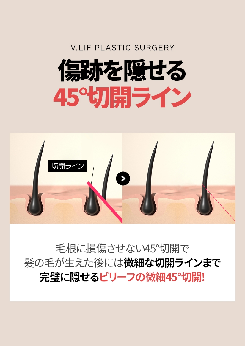 傷跡を隠せる 45°切開ライン 切開ライン 毛根に損傷させない45°切開で髪の毛が生えた後には 微細な切開ラインまで完璧に隠せるビリーフの微細45°切開!