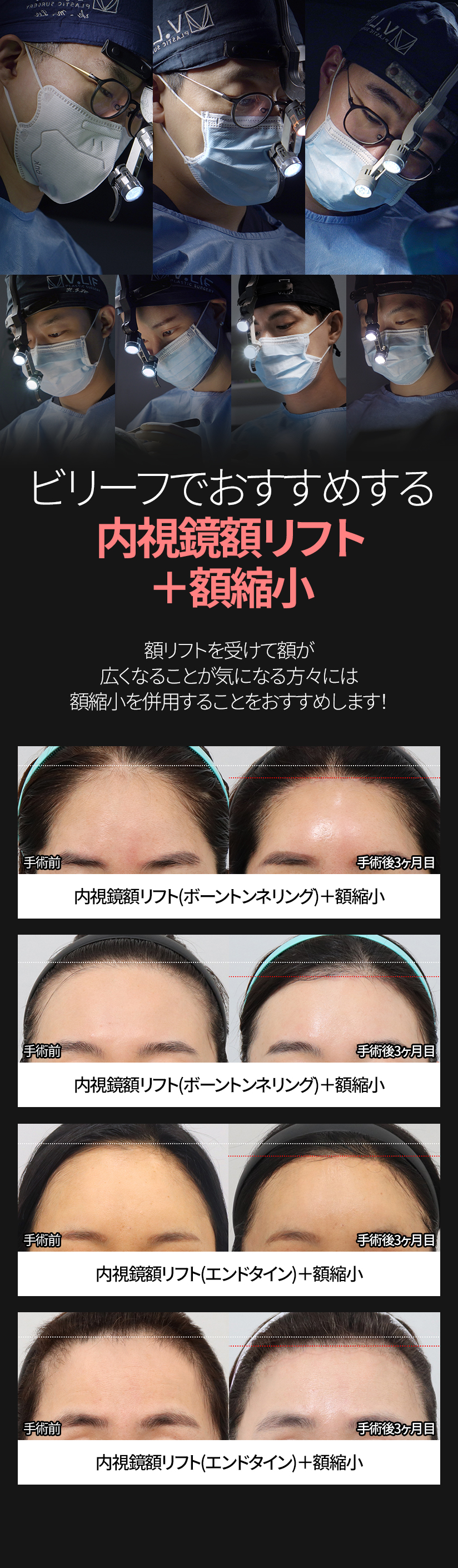 ビリーフでおすすめする 内視鏡額リフト＋額縮小 額リフトを受けて額が広くなることが気になる方々には 額縮小を併用することをおすすめします! 手術前 内視鏡額リフト(ボーントンネリング)＋額縮小 手術後3ヶ月目 手術前 v内視鏡額リフト(ボーントンネリング)＋額縮小 手術後3ヶ月目 手術前 内視鏡額リフト(エンドタイン)＋額縮小 手術後1ヶ月目 手術前  内視鏡額リフト(エンドタイン)＋額縮小 手術後3ヶ月目 