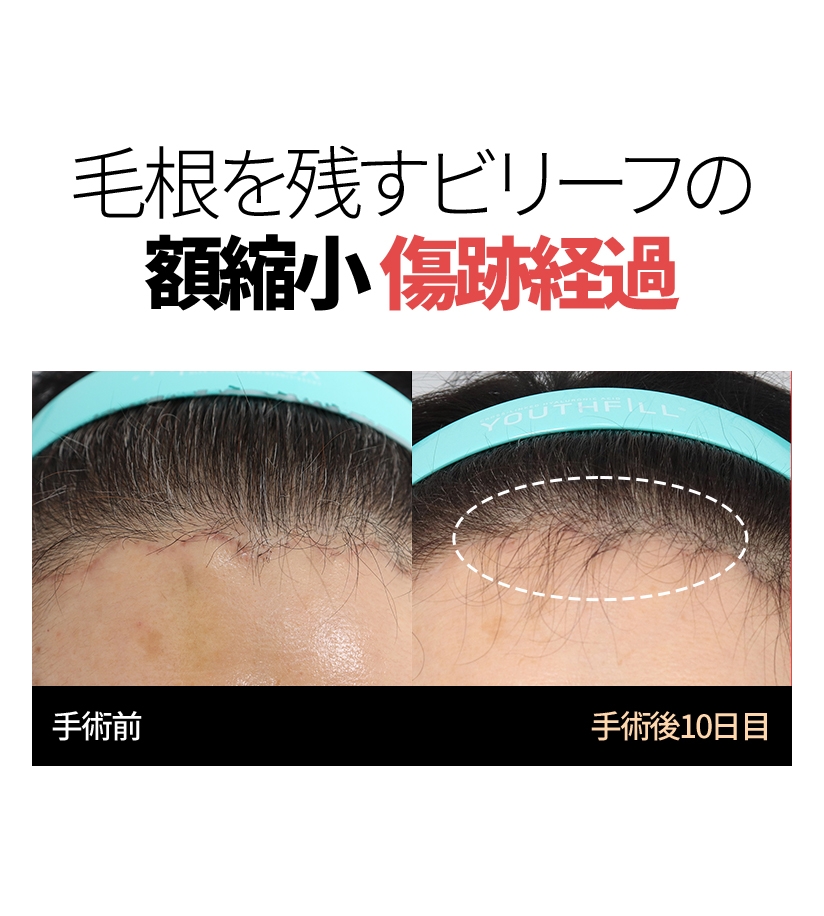 毛根を残すビリーフの 額縮小 傷跡経過 手術前 手術後10日目 
