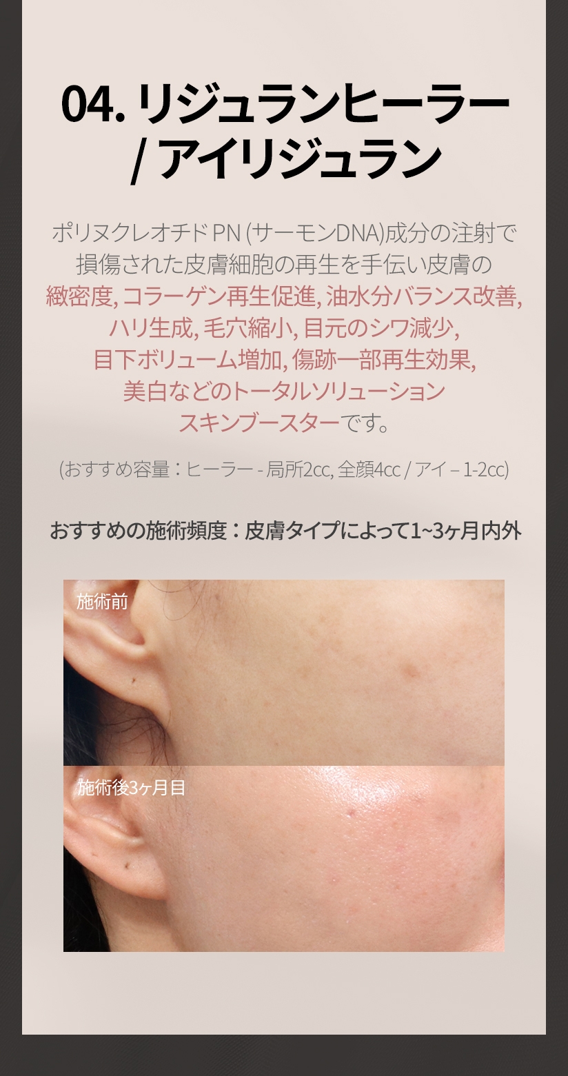 04. リジュランヒーラー / アイリジュラン ポリヌクレオチド PN (サーモンDNA)成分の注射で 損傷された皮膚細胞の再生を手伝い皮膚の 緻密度, コラーゲン再生促進, 油水分バランス改善, ハリ生成, 毛穴縮小, 目元のシワ減少,目下ボリューム増加, 傷跡一部再生効果, 美白などの トータルソリューションスキンブースターです。(おすすめ容量 ： ヒーラー - 局所2cc, 全顔4cc / アイ – 1-2cc) おすすめの施術頻度 ： 皮膚タイプによって 1~3ヶ月内外 