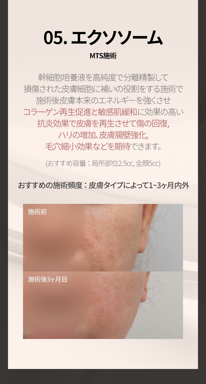 05. エクソソーム MTS施術 幹細胞培養液を高純度で分離精製して 損傷された皮膚細胞に補いの役割をする施術で 施術後皮膚本来のエネルギーを強くさせ コラーゲン再生促進と敏感肌緩和に効果の高い 抗炎効果で皮膚を再生させて傷の回復, ハリの増加, 皮膚腸壁強化, 毛穴縮小効果などを期待できます。 (おすすめ容量 ： 局所部位2.5cc, 全顔5cc) おすすめの施術頻度 ： 皮膚タイプによって 1~3ヶ月内外