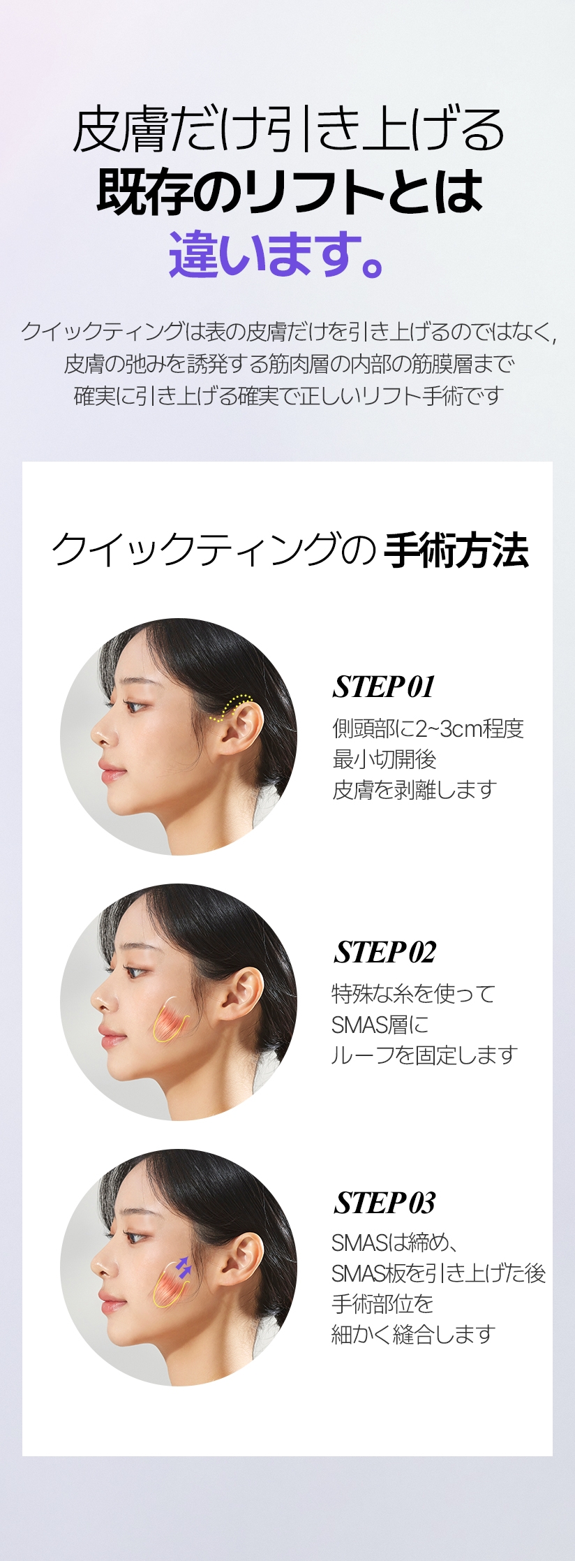 피부만 당기는 기존의 리프팅과는 다릅니다. 퀵프팅은 겉 피부만 당기는 것이 아닌, 피부의 처짐을 유발하는 근육층 내부의 근막층까지 확실하게 당겨주는 확실하고 올바른 리프팅입니다.-퀵프팅 수술과정 STEP 1. 측두부에 2-3cm 정도 최소 절개 후 피부 박리합니다. STEP 2. 특수한 실을 사용하여 스마스층에 루프 고정합니다. STEP 3. 스마스를 조여주고 스마스판을 당겨주고 수술 부위를 꼼꼼하게 봉합합니다.