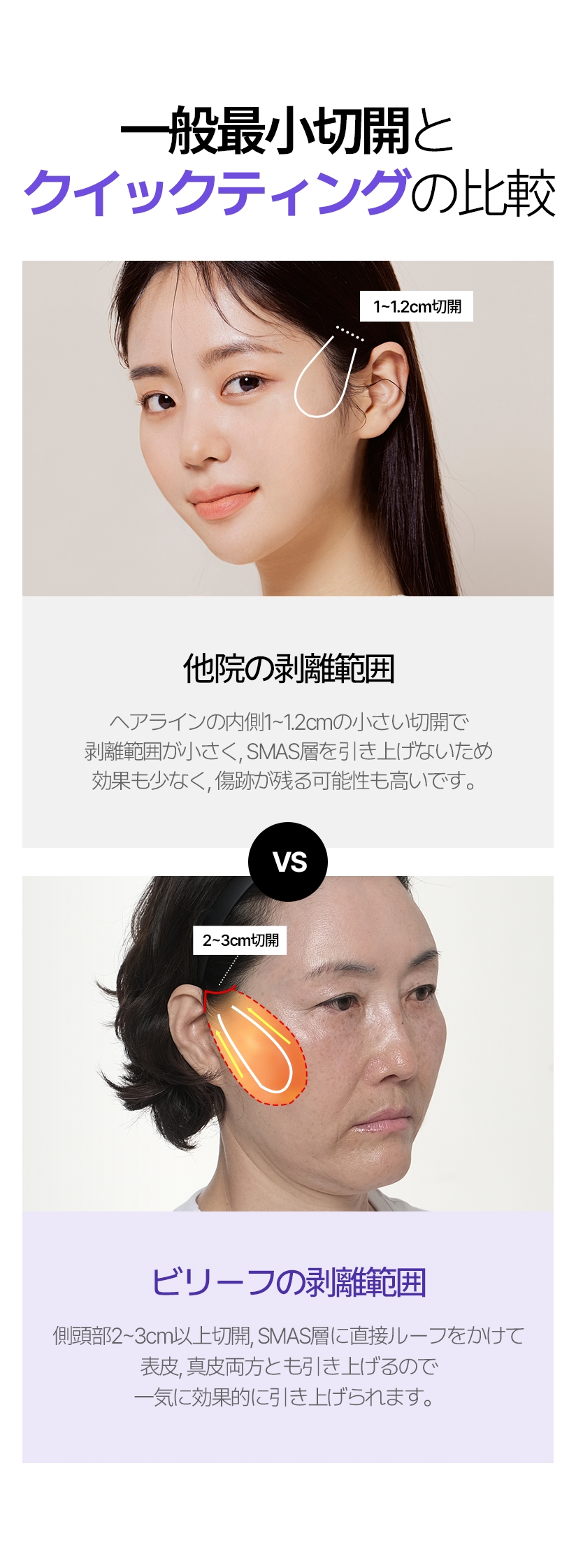 일반 최소절개와 퀵프팅 비교 타 병원의 박리범위 - 헤어라인 안쪽  1~1.2CM 의 작은 절개로 박리 범위가 작고 스마스층을 당기지 않아 효과가 미비하며 흉터 발생 확률이 높습니다. 빌리프의 박리범위 측두부 2~3cm 이상 절개 및 스마스층에 직접 루프를 걸어 표피, 진피 모두 당겨주므로 한번에 효과적인 리프팅이 가능합니다. 