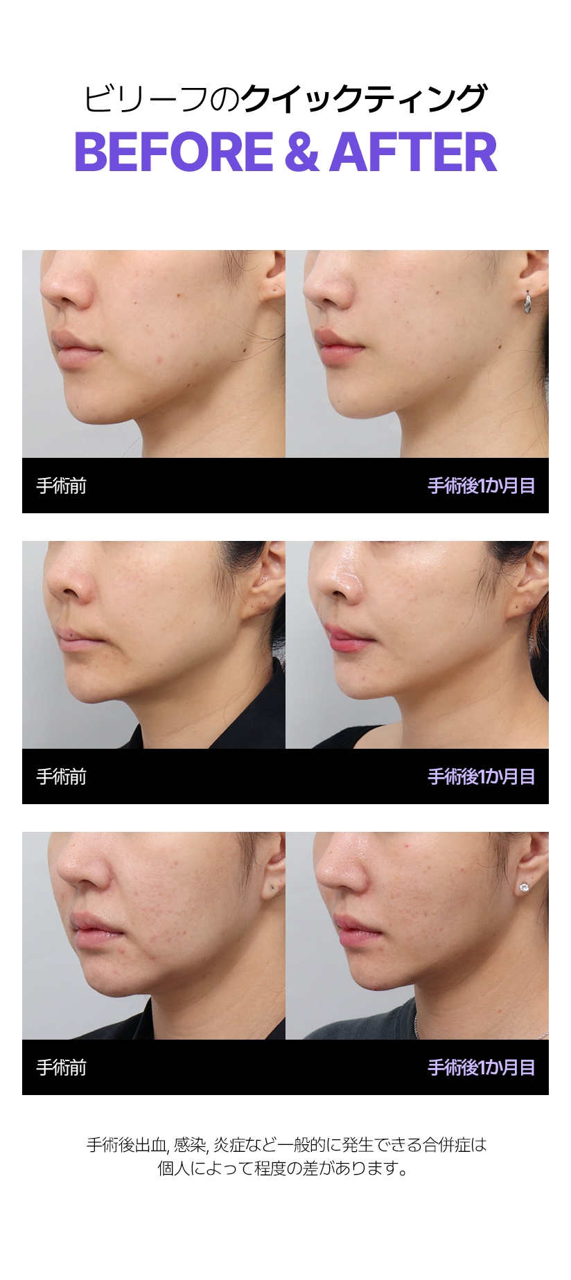 빌리프 퀵프팅 Before & After 수술전 - 1달차