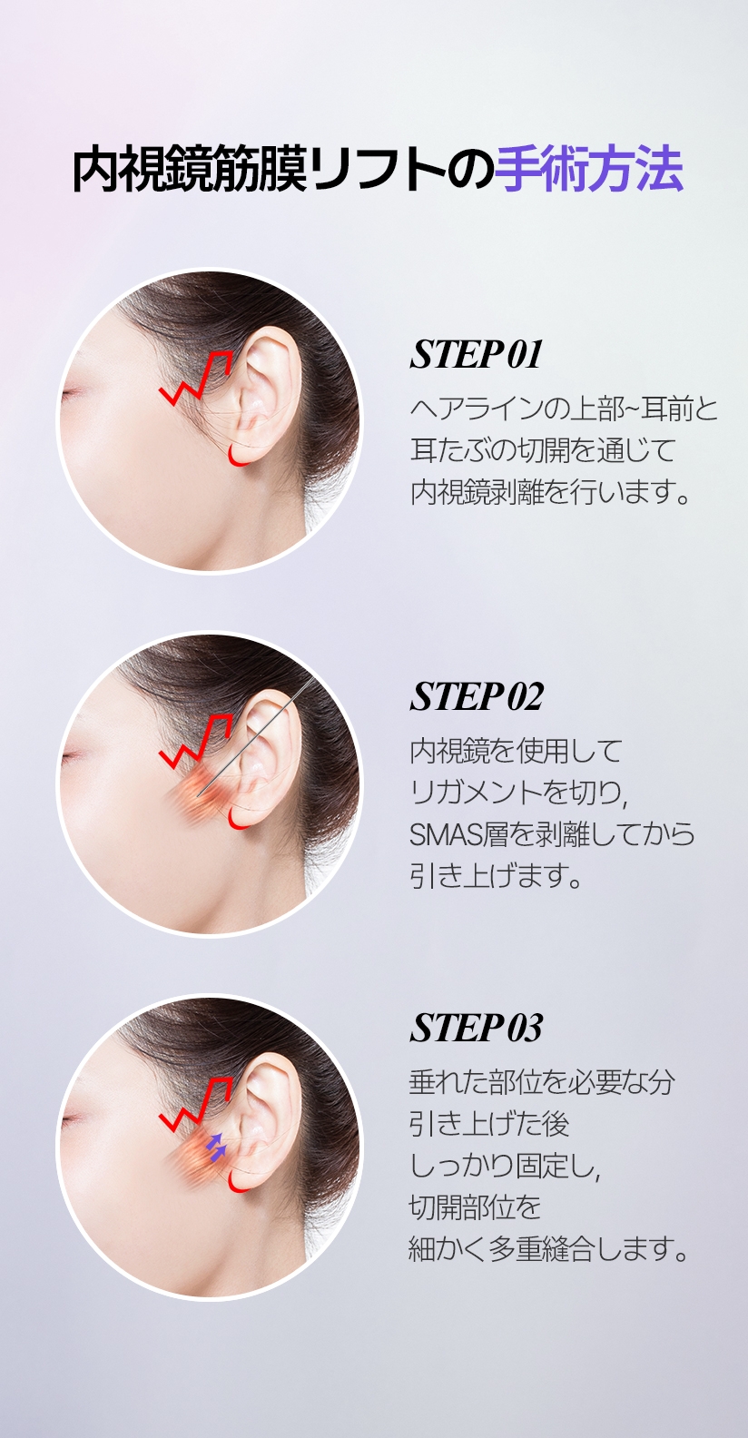 内視鏡筋膜リフトの手術方法 STEP 01 ヘアラインの上部~耳前と 耳たぶの切開を通じて 内視鏡剥離を行います。 STEP 02 内視鏡を使用してリガメントを 切り, SMAS層を剥離してから 引き上げます。 STEP 03 垂れた部位を必要な分引き上げた後 しっかり固定し, 切開部位を 細かく多重縫合します。