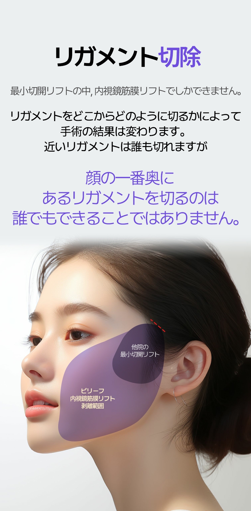 リガメント 切除  最小切開リフトの中, 内視鏡筋膜リフトでしかできません。 リガメントをどこからどのように切るかによって 手術の結果は変わります。 近いリガメントは誰も切れますが 顔の一番奥にあるリガメントを切るのは 誰でもできることではありません。他院の 最小切開リフト ビリーフ 内視鏡筋膜リフト 剥離範囲 