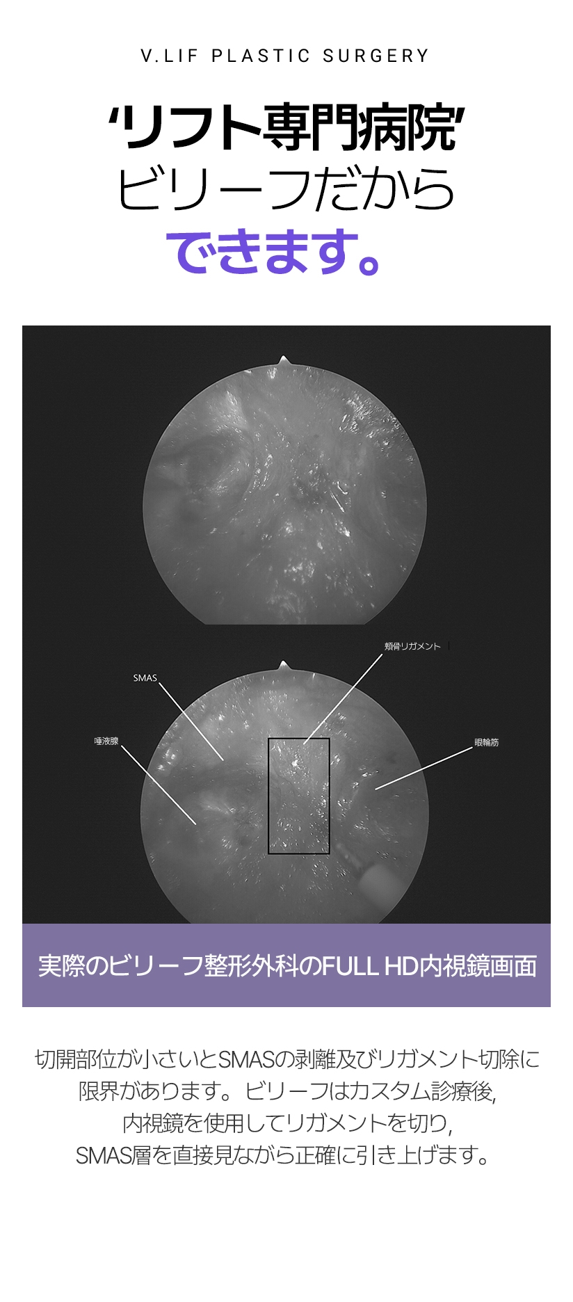‘リフト専門病院’ ビリーフだからできます。 実際のビリーフ整形外科のFULL HD内視鏡画面 切開部位が小さいとSMASの剥離及びリガメント切除に限界があります。 ビリーフはカスタム診療後, 内視鏡を使用して リガメントを切り, SMAS層を直接見ながら正確に引き上げます。