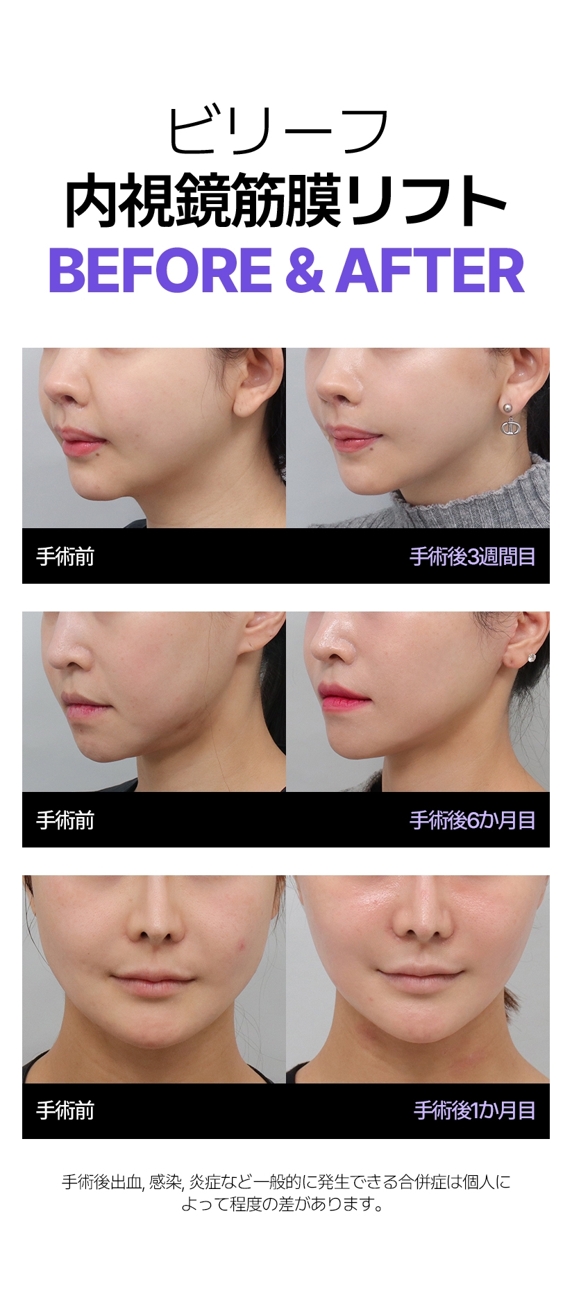ビリーフ  内視鏡筋膜リフト Before & After 手術前 手術後3週間目 手術前 手術後6か月目 手術前 手術後1か月目 手術後出血, 感染, 炎症など一般的に発生できる合併症は個人によって程度の差があります。