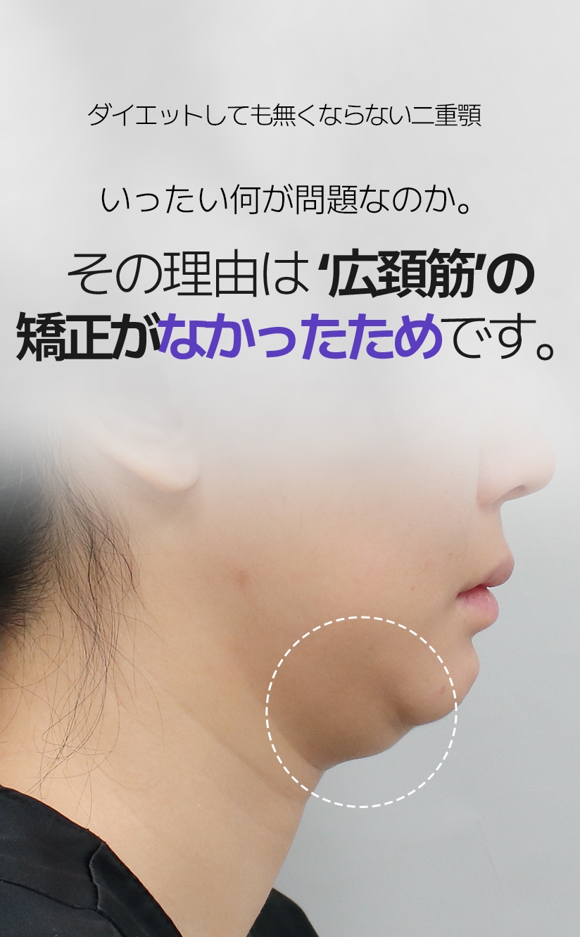 다이어트를 해도 없어지지 않는 이중턱 도대체 뭐가 문제일까? 그 이유는 ‘활경근’의 교정이 없었기 때문입니다.