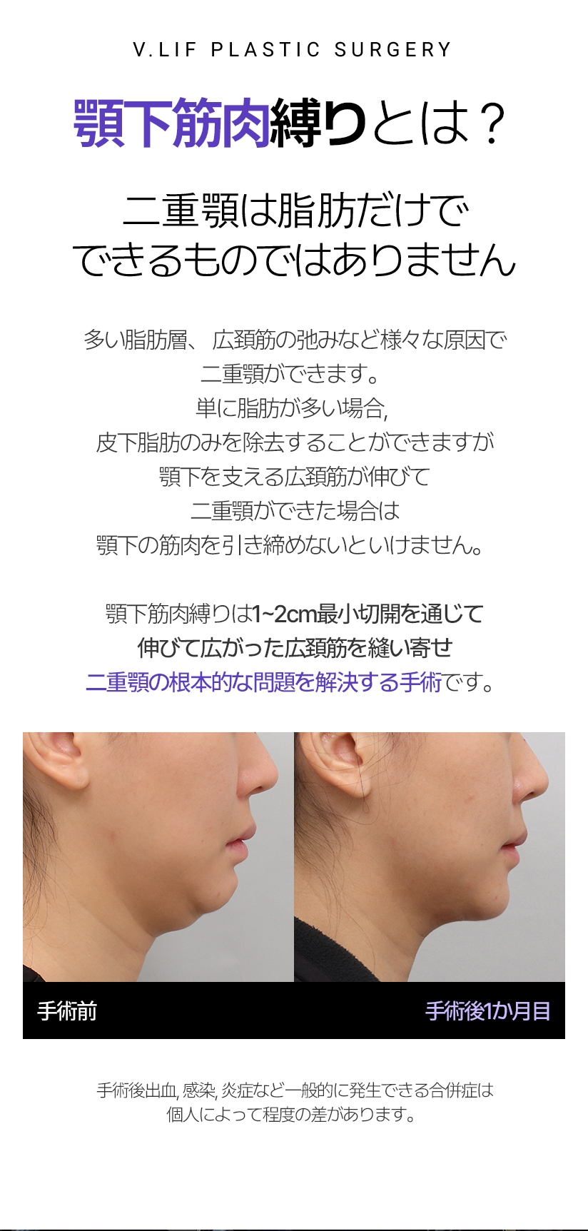 - 이중턱 근육묶기란? 이중턱은 지방으로만 생기지 않습니다. 지방층 과다, 활경근 늘어짐 등  다양한 원인으로 이중턱이 발생합니다. 단순히 지방이 많은 경우 피하지방만 제거가 가능하지만 턱 밑을 받치는 활경근의 늘어짐으로 이중턱이 발생했다면 턱 밑의 근육의 긴장도를 높여줘야 합니다. 이중턱 근육묶기는 1-2cm 최소절개를 통해늘어지고 벌어진 활경근을 당겨 모아 묶어 당겨주어 이중턱의 근본적인 문제를 해결하는 수술입니다. *수술 후 출혈, 감염, 염증 등 일반적으로 발생할 수 있는 합병증은 개인에 따라 정도의 차이가 발생할 수 있습니다.