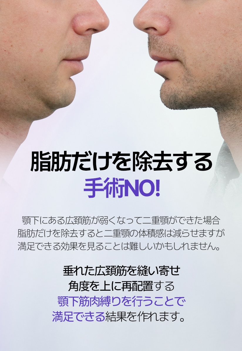 지방만 제거하는 수술 NO! 턱 밑 근육의 활경근이 약해져 이중턱이 생긴 경우 지방만 제거한다면 이중턱의 부피감은 줄일 수 있지만 만족스러운 효과를 보기 어려울 수 있습니다.늘어진 활경근을 묶어주고 각도를 위로 재배치하는 이중턱근육묶기를 해야 만족스러운 결과를 볼 수 있습니다.