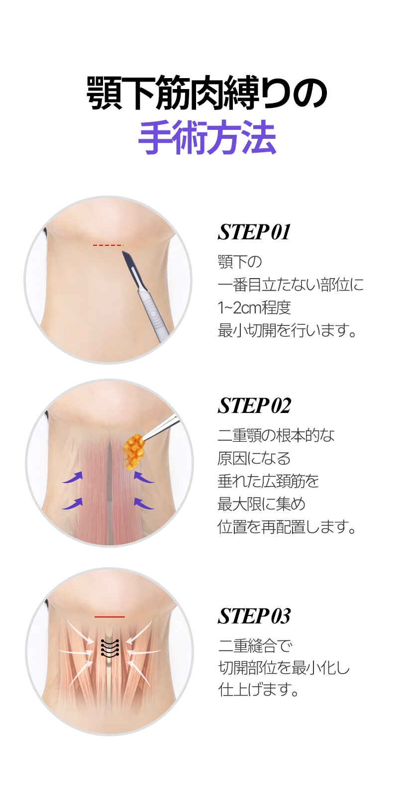 빌리프 이중턱근육묶기 수술과정 STEP 1. 턱밑 가장 안보이는 부위에 1-2cm 정도의 최소 절개 합니다./ STEP 2. 이중턱의 근본적인 원인이 되는 늘어진 활경근을 최대한 모아주어 위치를 재배치 합니다. / STEP 3. 이중봉합으로 절개부위를최소화하여 마무리합니다. 
