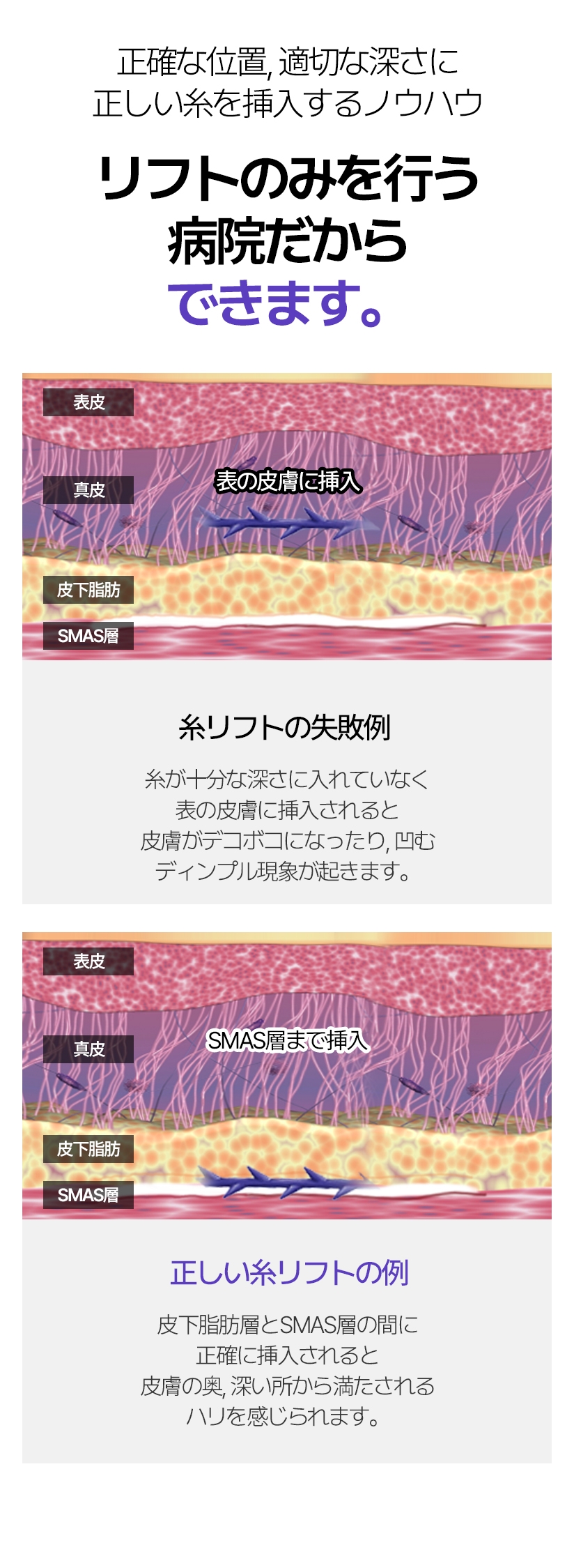正確な位置, 適切な深さに正しい糸を挿入するノウハウ  リフトのみを行う病院だからできます。 糸リフトの失敗例 糸が十分な深さに入れていなく 表の皮膚に挿入されると 皮膚がデコボコになったり, 凹む ディンプル現象が起きます。正しい糸リフトの例 皮下脂肪層とSMAS層の間に 正確に挿入されると 皮膚の奥、深い所から満たされる ハリを感じられます。