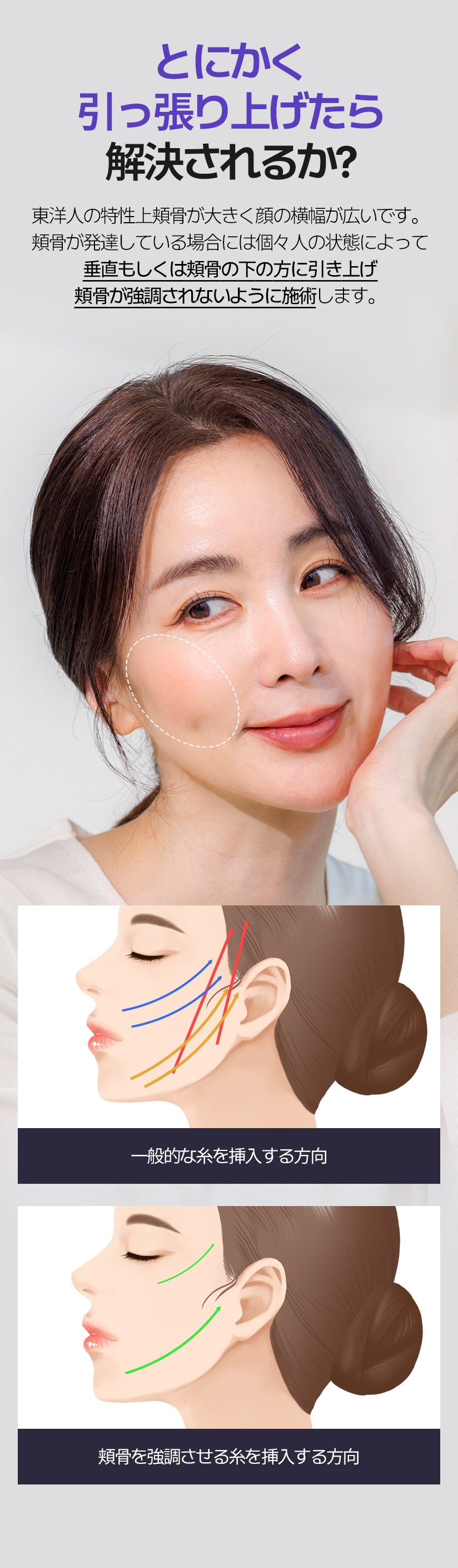 とにかく 引っ張り上げたら 解決されるか?  東洋人の特性上頬骨が大きく顔の横幅が広いです。 頬骨が発達している場合には個々人の状態によって 垂直もしくは頬骨の下の方に引き上げ 頬骨が強調されないように施術します。 一般的な糸を挿入する方向 頬骨を強調させる糸を挿入する方向