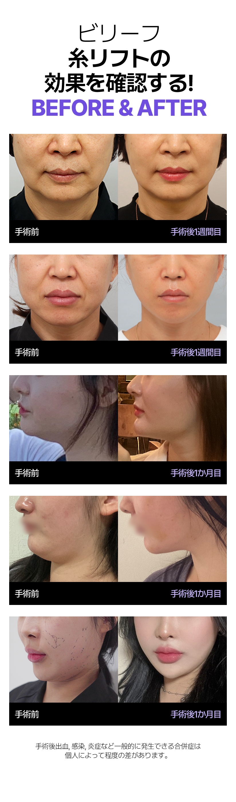 ビリーフ 糸リフトの効果を確認する! Before & After 手術前 手術後1週間目 手術前 手術後1か月目 手術前 手術後1か月目 手術前 手術後1か月目 手術前 手術後1か月目 手術後出血, 感染, 炎症など一般的に発生できる合併症は個人によって程度の差があります。