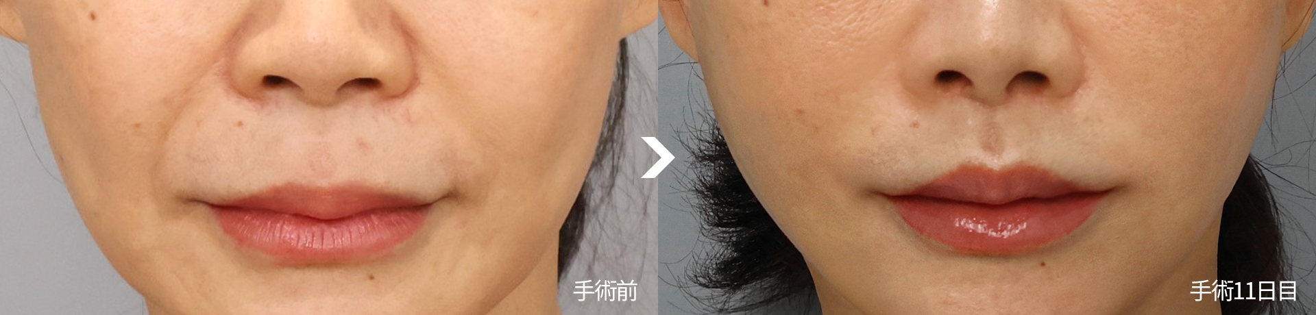 手術前 手術11日目