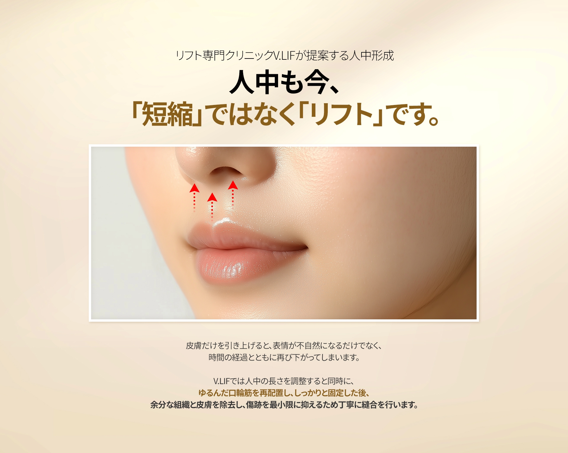 リフト専門クリニックV.LIFが提案する人中形成 人中も今、「短縮」ではなく「リフト」です。 皮膚だけを引き上げると、表情が不自然になるだけでなく、 時間の経過とともに再び下がってしまいます。 V.LIFでは人中の長さを調整すると同時に、 ゆるんだ口輪筋を再配置し、しっかりと固定した後、 余分な組織と皮膚を除去し、傷跡を最小限に抑えるため丁寧に縫合を行います。