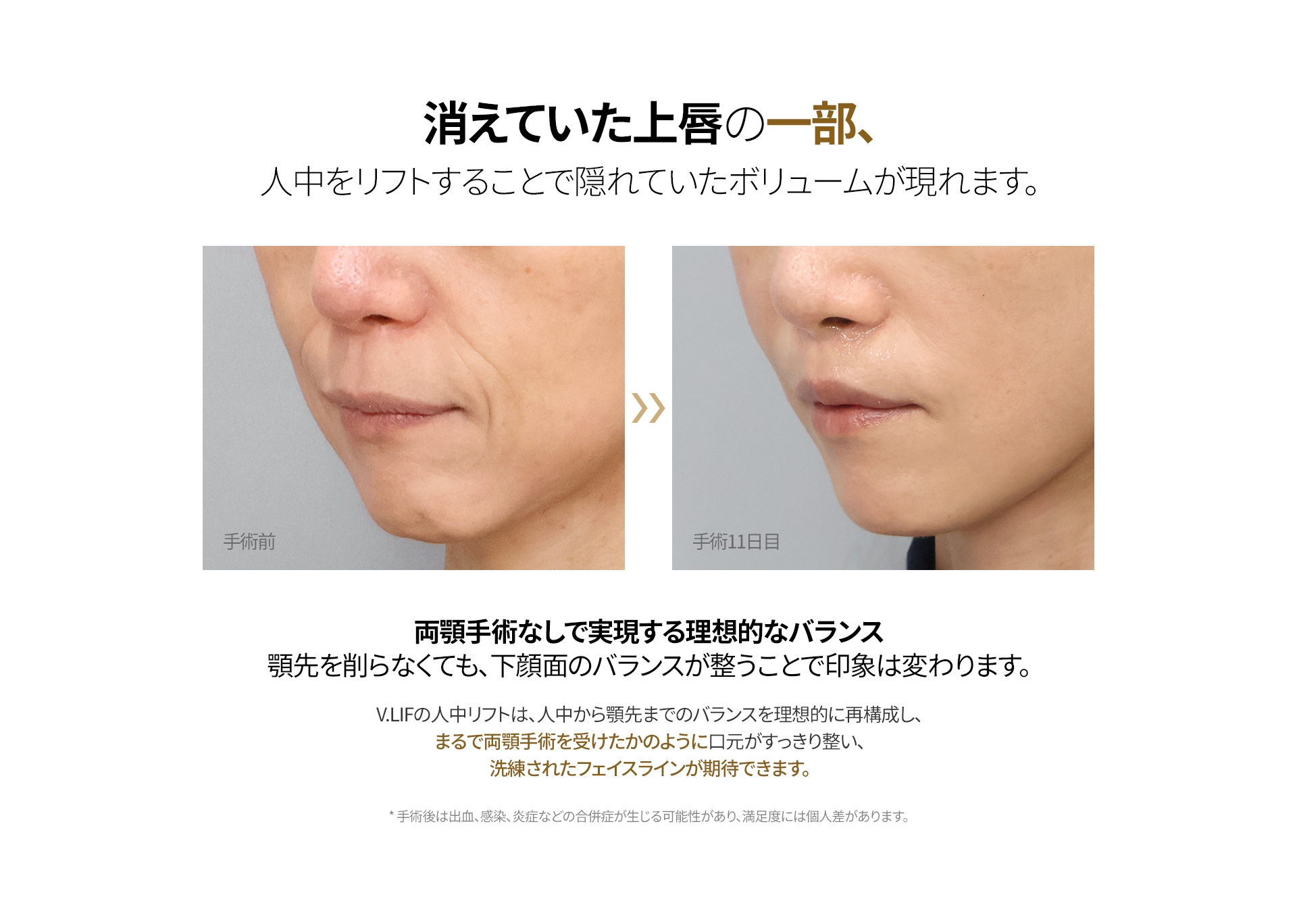 消えていた上唇の一部、人中をリフトすることで隠れていたボリュームが現れます。両顎手術なしで実現する理想的なバランス 顎先を削らなくても、下顔面のバランスが整うことで印象は変わります。 V.LIFの人中リフトは、人中から顎先までのバランスを理想的に再構成し、 まるで両顎手術を受けたかのように口元がすっきり整い、 洗練されたフェイスラインが期待できます。 *手術後は出血、感染、炎症などの合併症が生じる可能性があり、満足度には個人差があります。