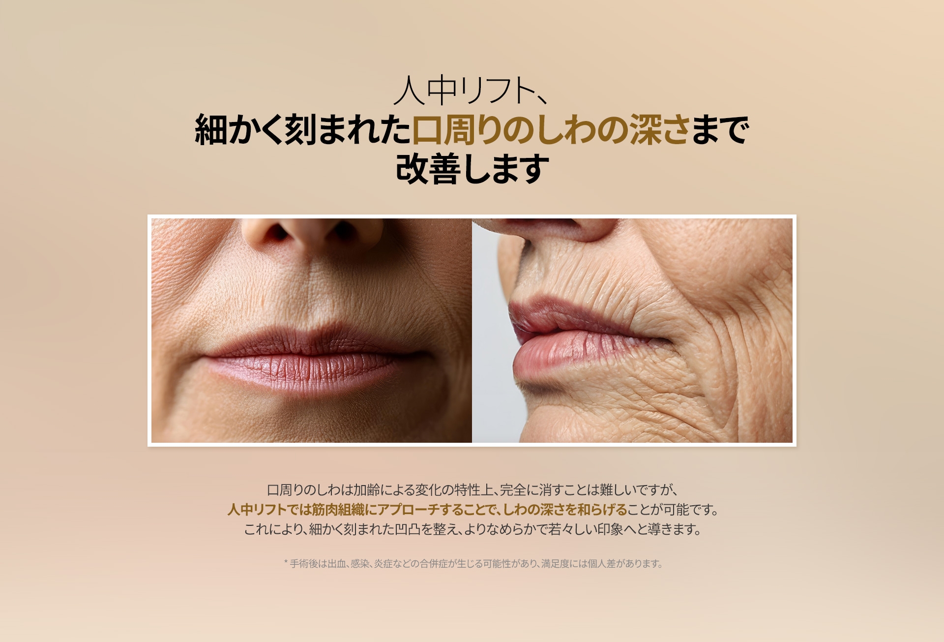 人中リフト 、 細かく刻まれた口周りのしわの深さまで 改善します 口周りのしわは加齢による変化の特性上、完全に消すことは難しいですが、 人中リフトでは筋肉組織にアプローチすることで、しわの深さを和らげることが可能です。 これにより、細かく刻まれた凹凸を整え、よりなめらかで若々しい印象へと導きます。 *手術後は出血、感染、炎症などの合併症が生じる可能性があり、満足度には個人差があります。