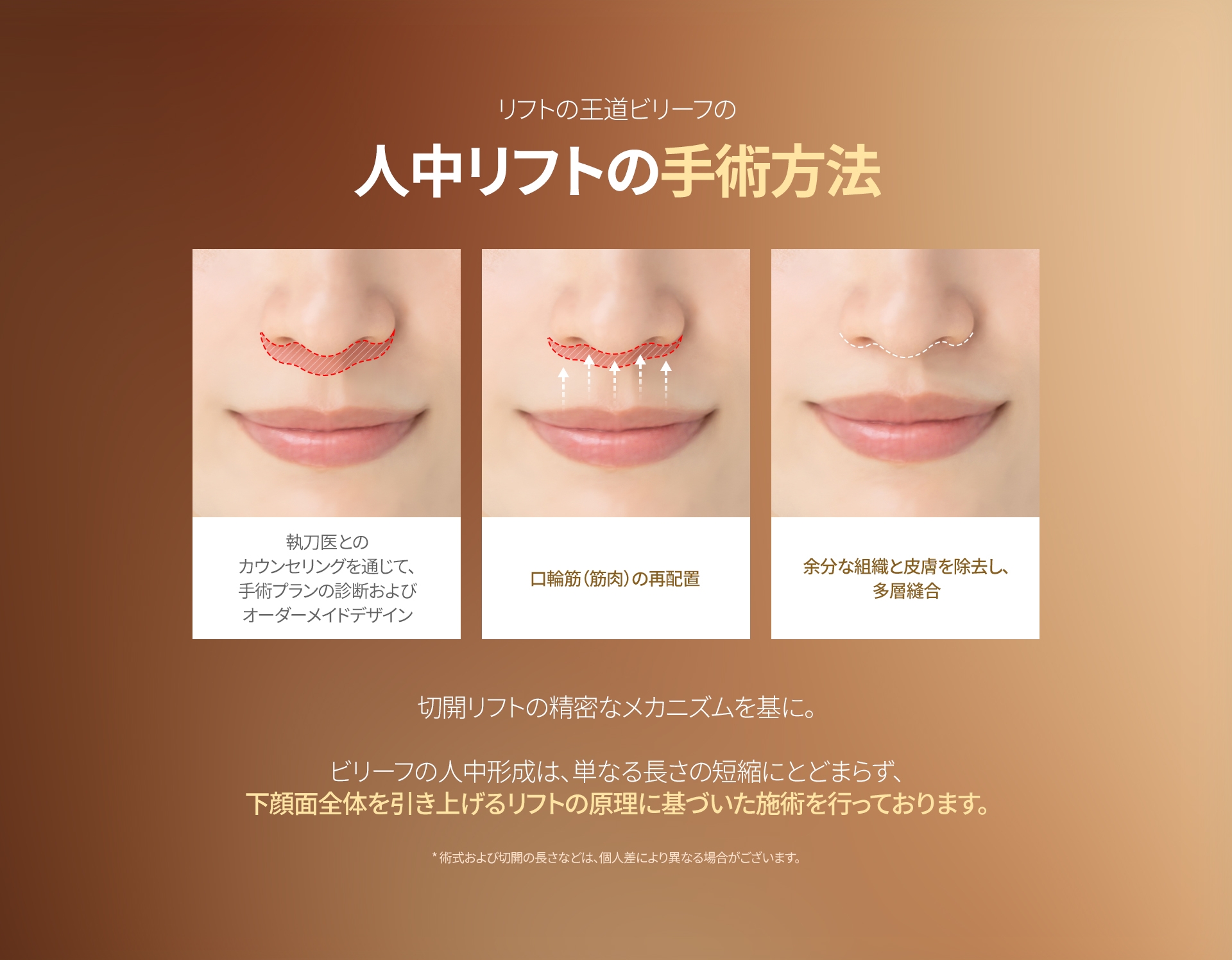 リフトの王道ビリーフの 人中リフトの手術方法 執刀医とのカウンセリングを通じて、 手術プランの診断およびオーダーメイドデザイン 口輪筋（筋肉）の再配置 余分な組織と皮膚を除去し、 多層縫合 切開リフトの精密なメカニズムを基に。 ビリーフの人中形成は、単なる長さの短縮にとどまらず、 下顔面全体を引き上げるリフトの原理に基づいた施術を行っております *術式および切開の長さなどは、個人差により異なる場合がございます。