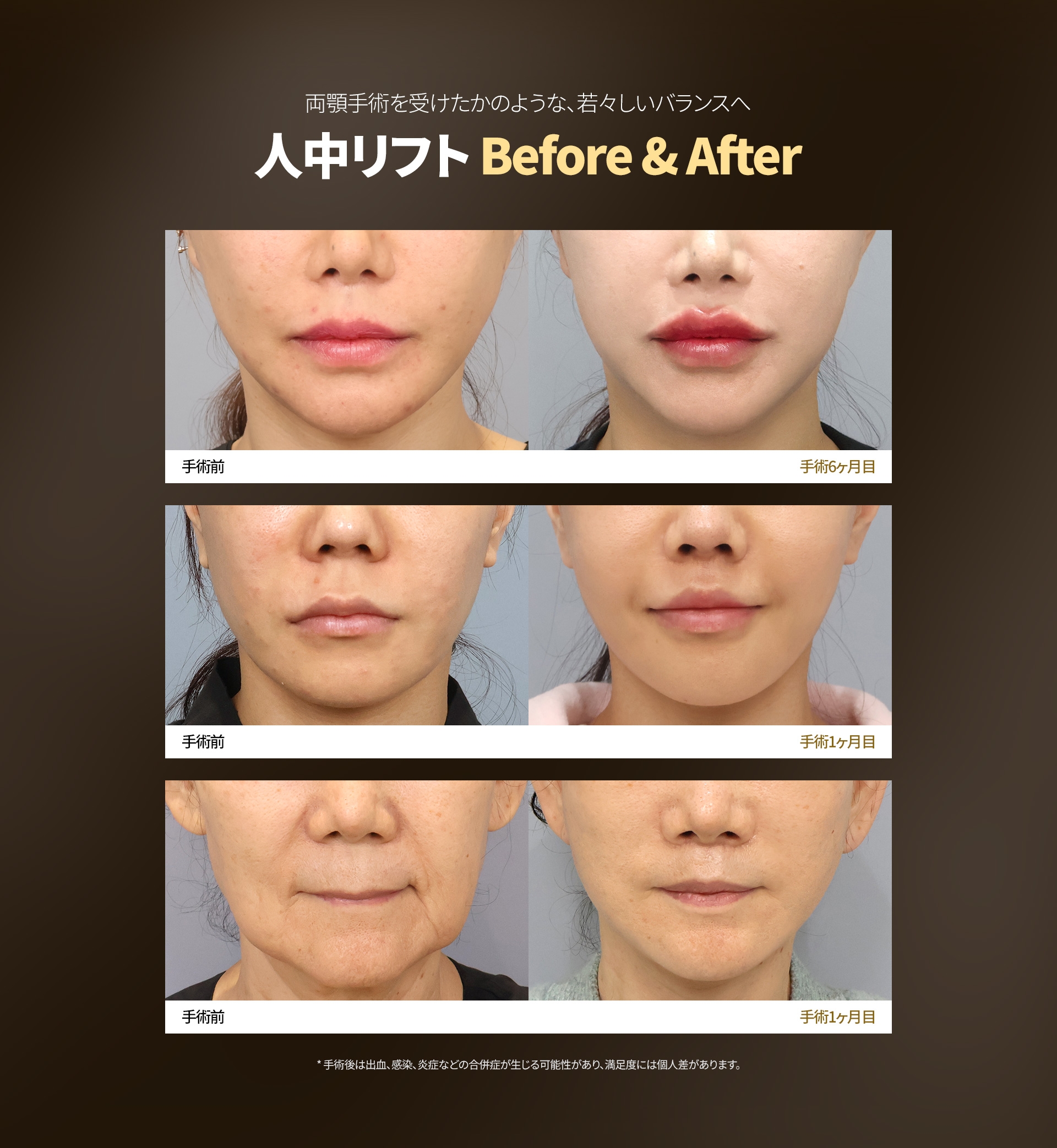 両顎手術を受けたかのような、若々しいバランスへ 人中リフト  Before & After *手術後は出血、感染、炎症などの合併症が生じる可能性があり、満足度には個人差があります。